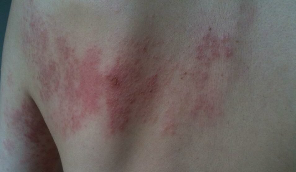 Herpes Zóster: Alerta sanitaria para mayores de 50 años en Costa Rica