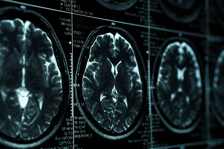 ¿Puede el litio convertirse en la nueva esperanza contra el Alzheimer?