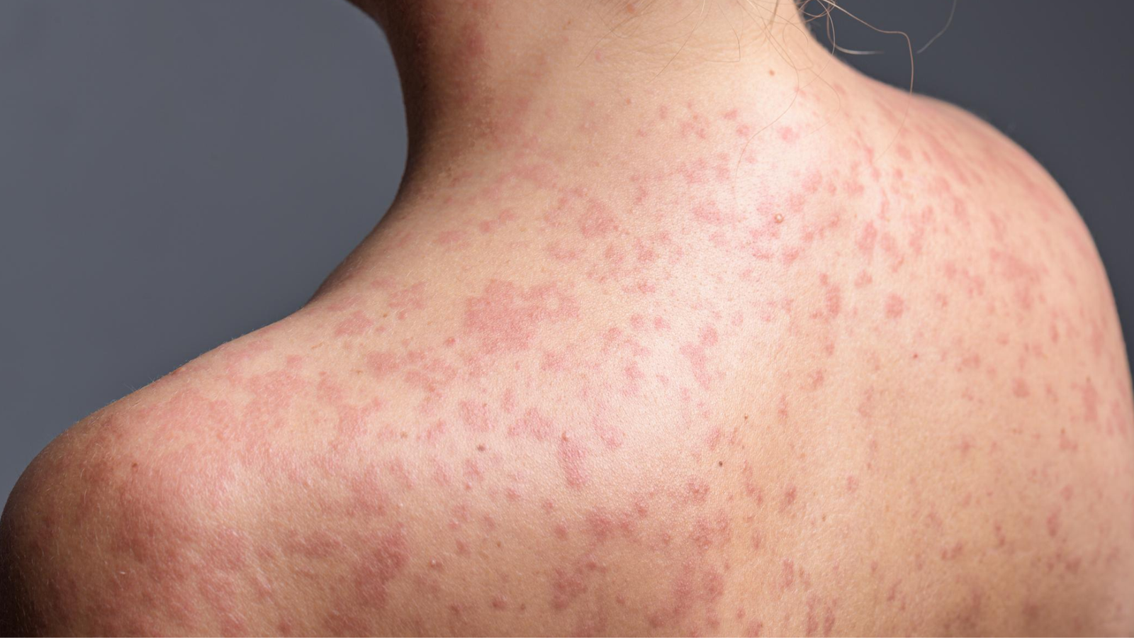 Costa Rica activa protocolo sanitario por caso importado de sarampión: ¿qué deben saber las personas mayores?