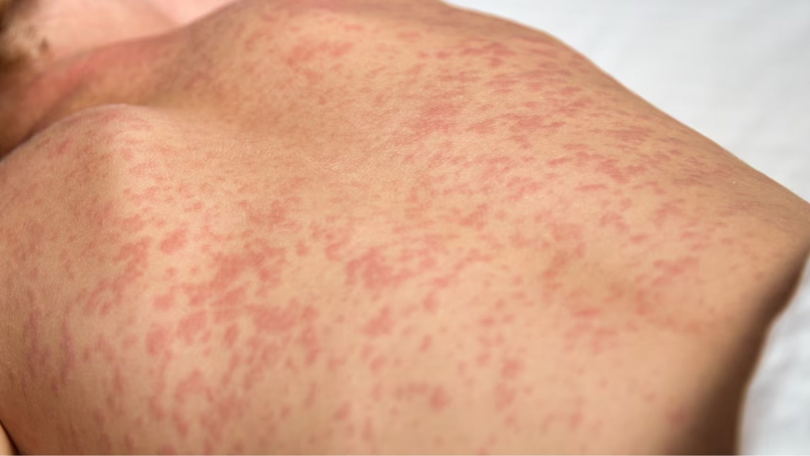 Salud confirma nuevo caso de sarampión en Costa Rica y activa medidas preventivas en centro educativo